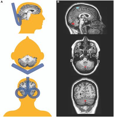 Cerebellar transcranial magnetic stimulation in psychotic disorders: intermittent, continuous, and sham theta-burst stimulation on time perception and symptom severity